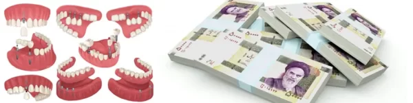 هزینه ایمپلنت دندان در شهریار