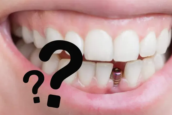 سوالات متداول ایمپلنت دندان