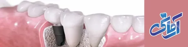 سوالات پر تکرار ایمپلنت دندان