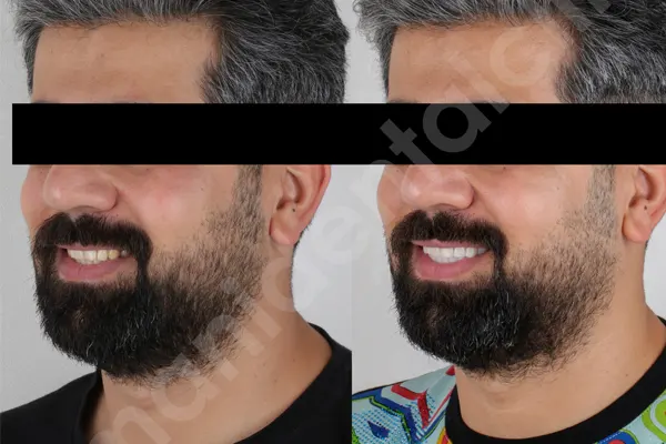 مراقبت های بعد از کامپوزیت ونیر 1 مراقبت های بعد از کامپوزیت ونیر