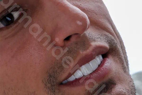 قیمت کامپوزیت دندان در شهریار سال 1404 1 هزینه کامپوزیت ونیر دندان در شهریار