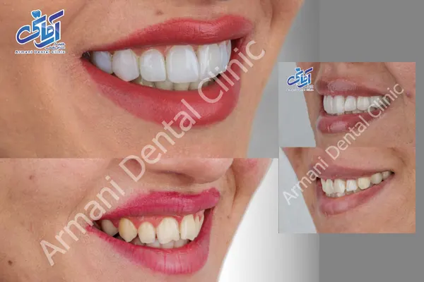 آیا کامپوزیت باعث بوی بد دهان می شود؟