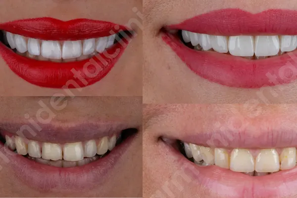 لمینت سرامیکی و ونیر کامپوزیت