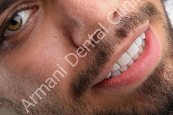 حساس شدن دندان بعد از کامپوزیت