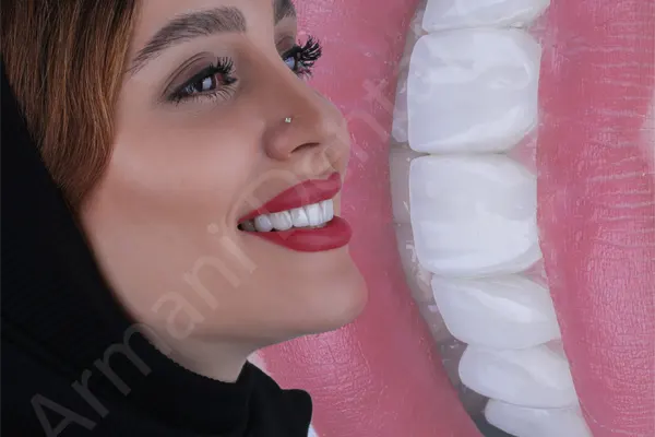 درد دندان بعد از کامپوزیت