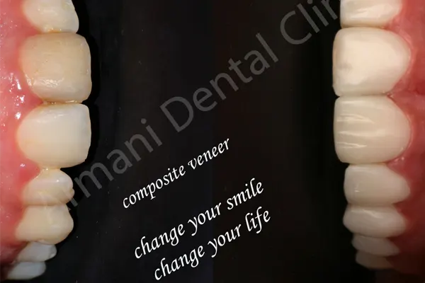 عمر کامپوزیت ونیر