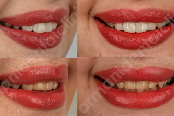 مزایای کامپوزیت ونیر دندان