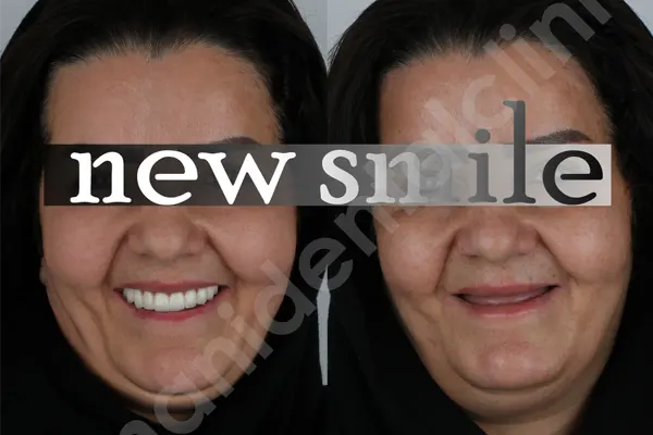 مشاوره ایمپلنت دندان و ضرورت آن 1 مشاوره ایمپلنت دندان