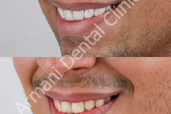 بعد از کامپوزیت دندان چه بخوریم 1 بعد از کامپوزیت دندان چه بخوریم