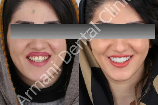 دلایل سیاه شدن روکش دندان