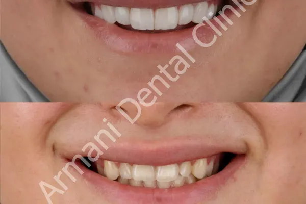 سیاه شدن کامپوزیت دندان