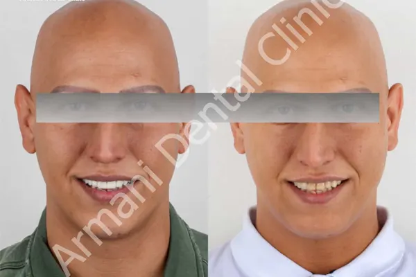 علل تغییر رنگ کامپوزیت ونیر