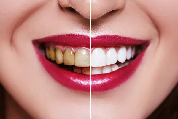 آیا لمینت به عنوان محافظ دندان عمل می کند ؟