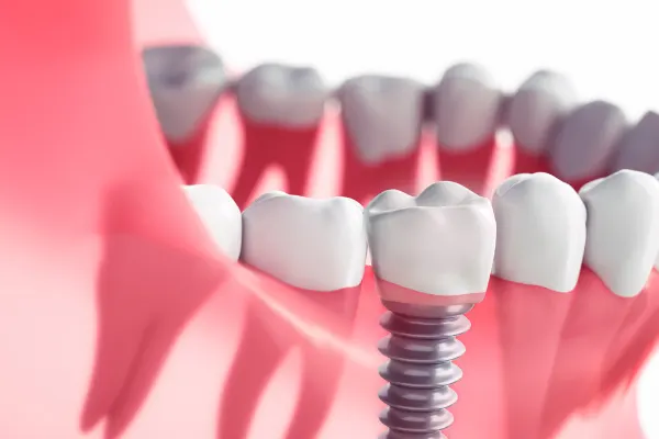 ایمپلنت دندان برای بیماران قلبی مضر است؟
