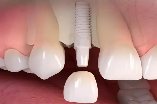 ایمپلنت زیرکونیا بهتر است یا ایمپلنت تیتانیوم؟