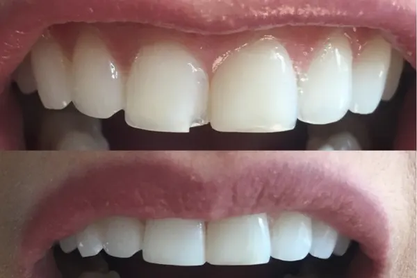 باندینگ دندان چیست