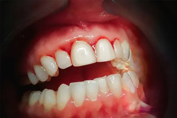 برای کنترل و از بین بردن خونریزی لثه