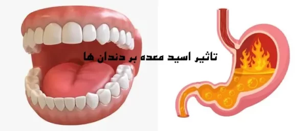 تاثیر اسید معده بر دندان ها