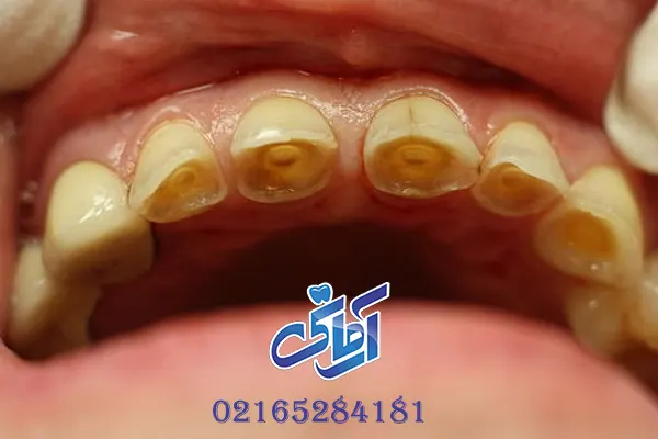 تاثیر اسید معده بر دندان ها و 2 روش پیشگیری از آن 1 تاثیر اسید معده بر دندان