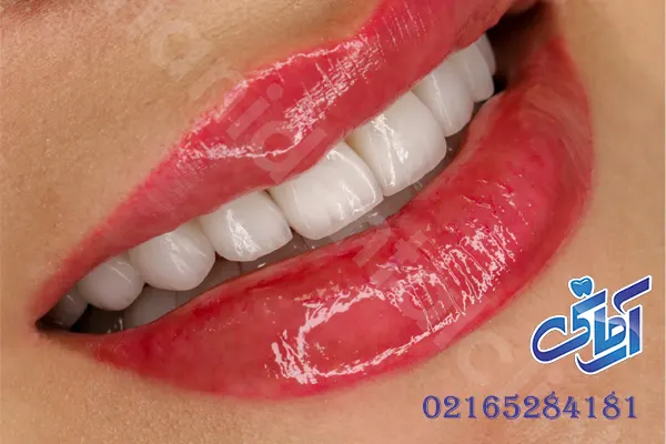 لمینت دندان با قیمت مناسب
