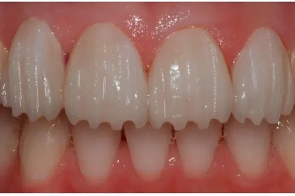 نحوه تراش دندان برای لمینت دندان