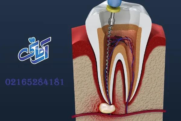 هزینه عصب کشی دندان