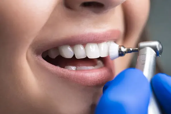 پولیش لمینت دندان