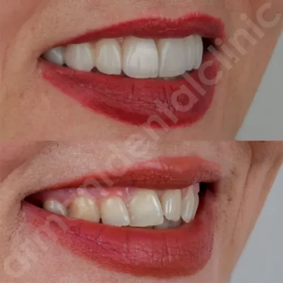لمینیتهاى سرامیکى