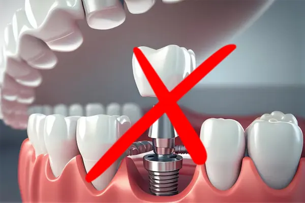 ارزان ترین و بهترین 5 روش کاشت دندان بدون ایمپلنت در شهریار 1 کاشت دندان بدون ایمپلنت