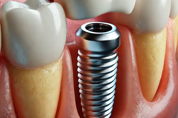 بهترین کلینیک ایمپلنت در شهریار 1 بهترین کلینیک ایمپلنت در شهریار