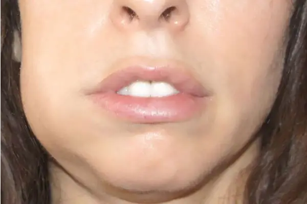 افتادگی صورت بعد از کشیدن دندان