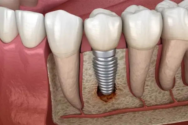 علت لق شدن ایمپلنت دندان، شل شدن پیچ ایمپلنت به چه دلیل رخ می دهد؟ 1 لق شدن ایمپلنت دندان 1