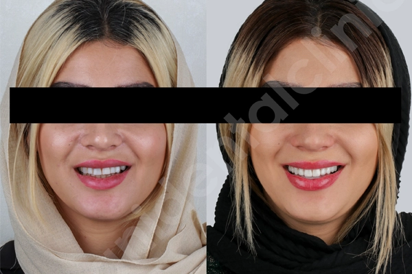 نظرات مردم درباره لمینت دندان در شهریار