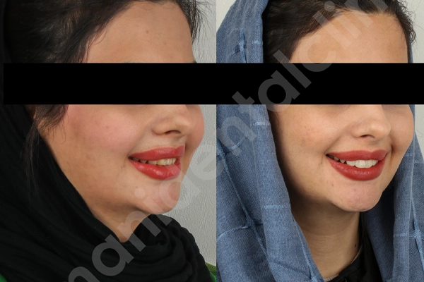 مردم درباره کامپوزیت دندان 2