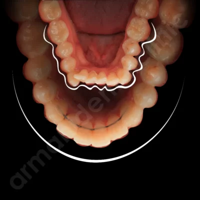 مراقبت های حین درمان ارتودنسی (در طول درمان) 1 در کلینیک آرمانی 30