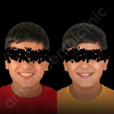 ارتودنسی دندان برای چه کسانی است؟ 1 در کلینیک آرمانی 43