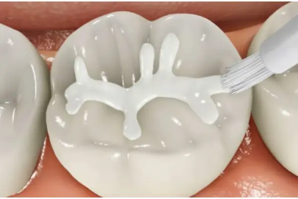 فیشورسیلانت