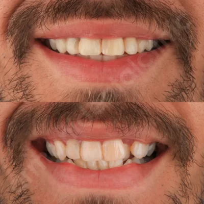 مراقبت های قبل ارتودنسی دندان و نکات مهمی که باید بدانید. 3 در کلینیک آرمانی 3