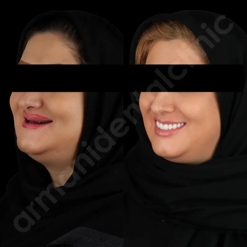 آرمانی 11
