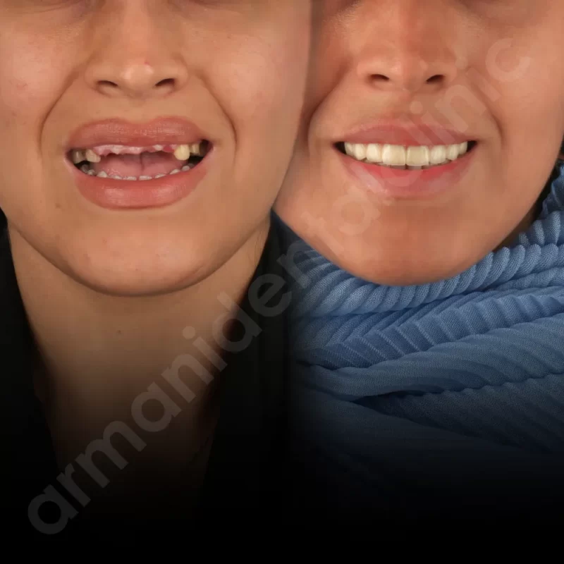 آرمانی 4