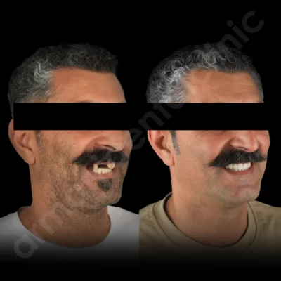 ایمپلنت دندان در شهریار
