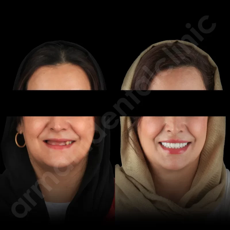 آرمانی 77