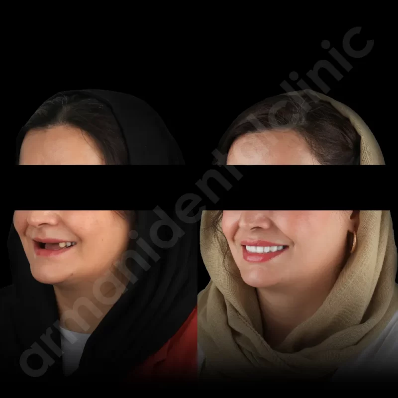 آرمانی 78